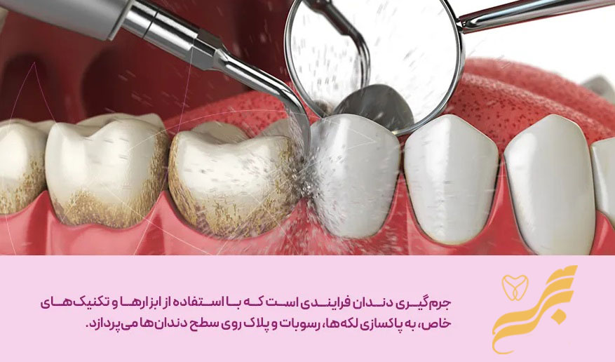 جرم گیری دندان