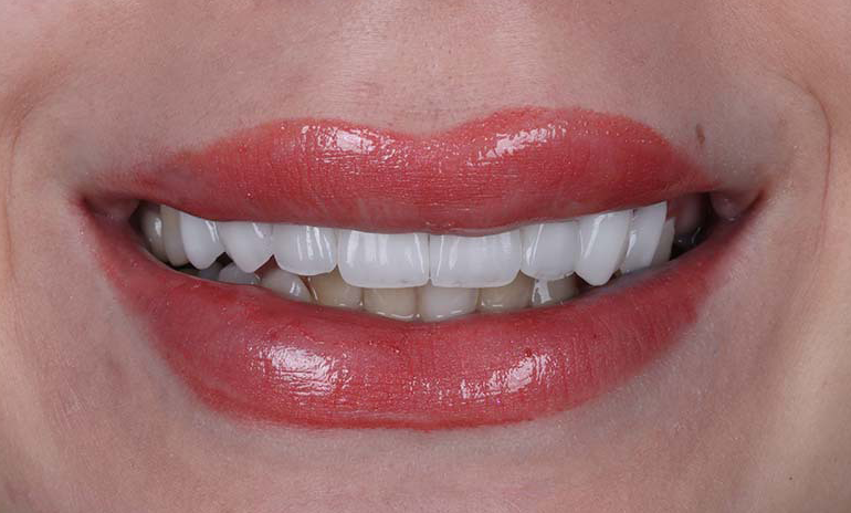 نمونه کار لمینت دندان پزشکی برتر